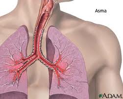 cara mengobati asma secara alami